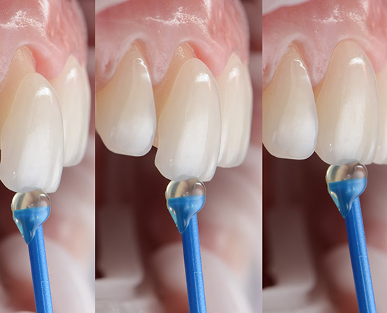 Series shots of dental veneer placement and installation on the tooth.