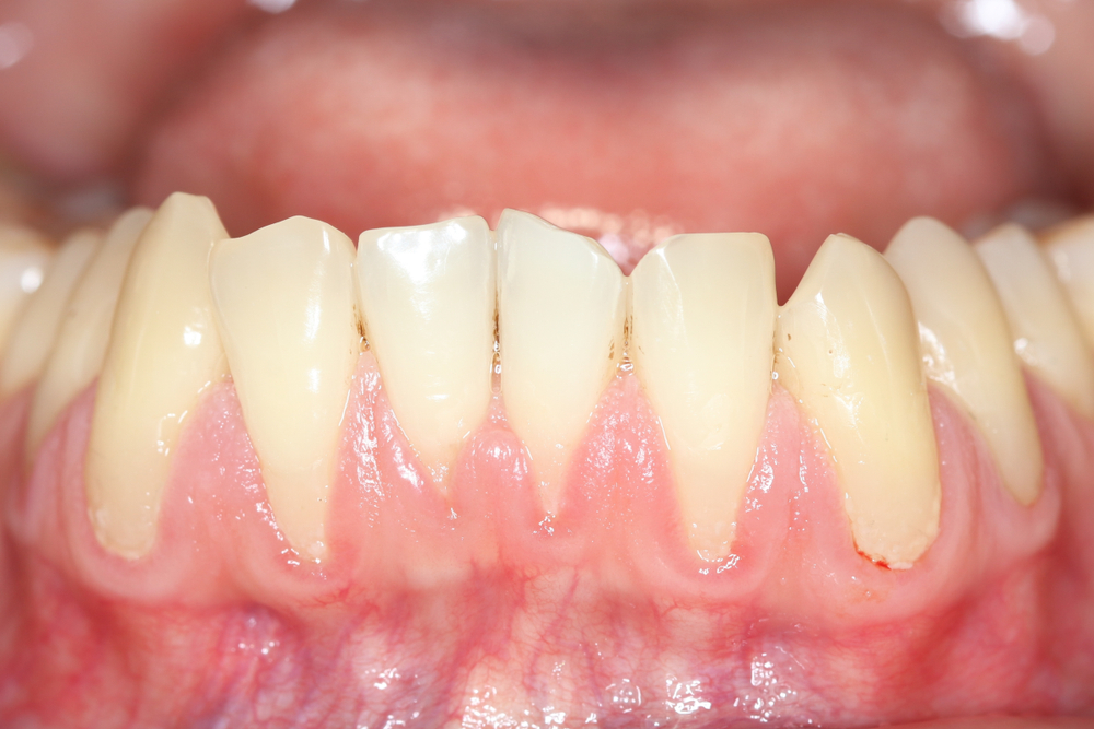 Gingival,Recession,,Also,Known,As,Receding,Gums,,Is,The,Exposure