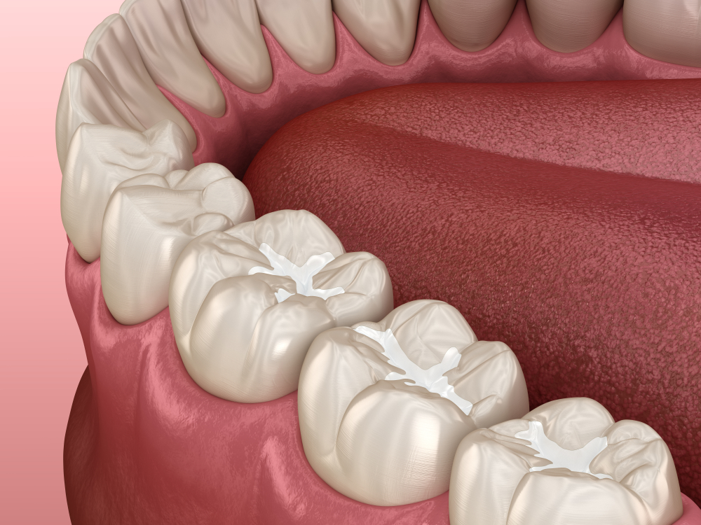 Molar,Fissure,Dental,Fillings,,Medically,Accurate,3d,Illustration,Of,Dental