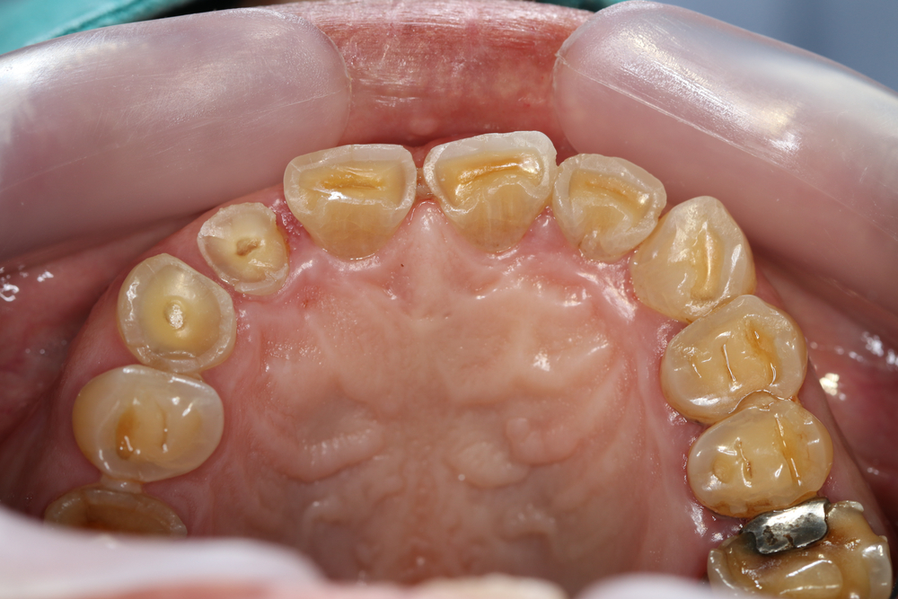 Severe,Teeth,Attrition,With,Loss,Of,Vertical,Dimension