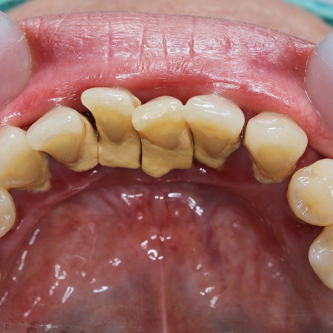 Tartar,In,Teeth,Or,Dental,Calculus,At,Lower,Anterior,Tooth